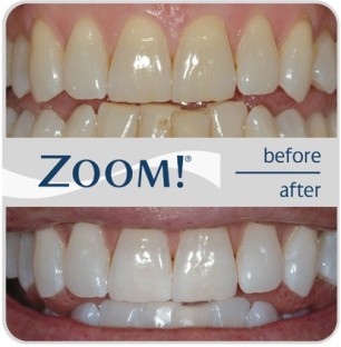 Teeth before and after whitening treatment
